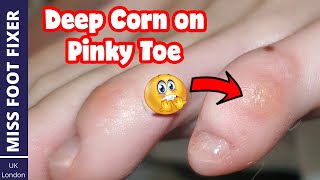 Old Patient Having Deep Corn On Pinky Toe *** How To Treat Corn On Foot *** by miss foot fixer