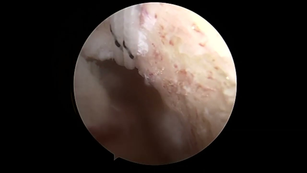 Fertilized ACL with Complex Double Sutureloc Meniscal Root Repair