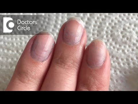 What causes bluish discoloration of nail beds? - Dr. Rashmi Ravindra