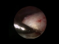 Calcific Tendonitis - Shoulder - Arthroscopic Surgery, by Laith Farjo, MD