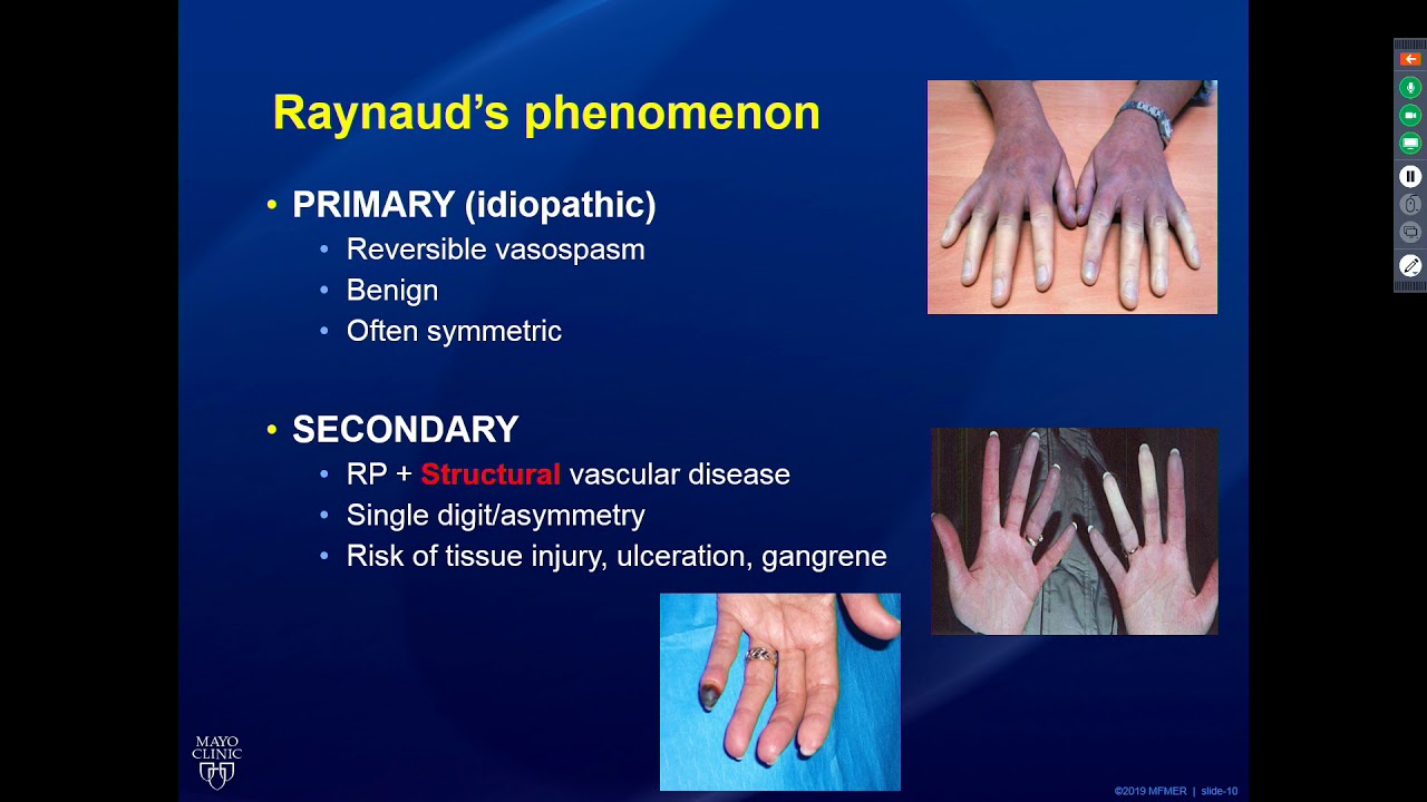 Rheumatology Pearls in Systemic Sclerosis  9/18/19