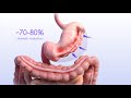 Endoscopic Gastric Sleeve ESG Procedure Animation Apolloendo Com Esg