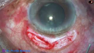 Large Incision cataract surgery (LICS) or Double SICS for a Black Cataract : P Mohanta, 3 Nov, 2020