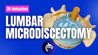 Download lagu Lumbar Microdiscectomy - 3D Animation mp3