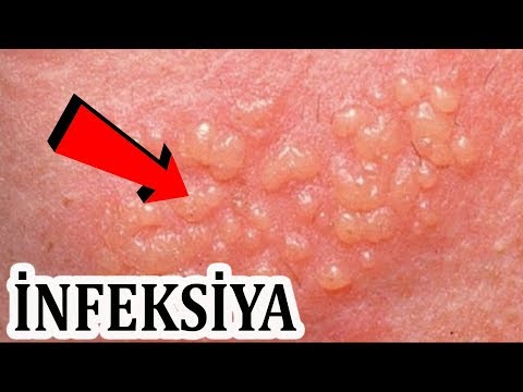 Ureaplasma és Mycoplasma fertőzések – Biztonsászovetsegtv.hu