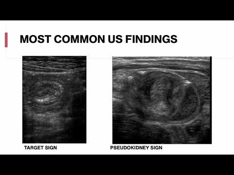 Pediatric Abdominal Ultrasound - Appendicitis, Intussusception, Mesenteric Adenitis