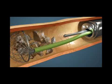 Cirugía de Cálculo de Ureter