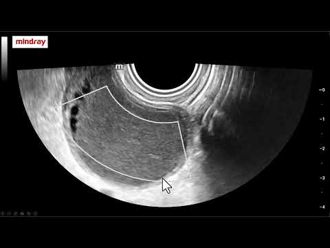 Cisto ovariano com ecotextura em vidro fosco. Achados ecográficos típicos e significado clínico.
