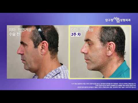  이마·안면거상 하기 위해 미국에서 ✈️ 한국까지!