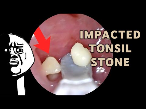Impacted Tonsil Stone Removal | AIM 21