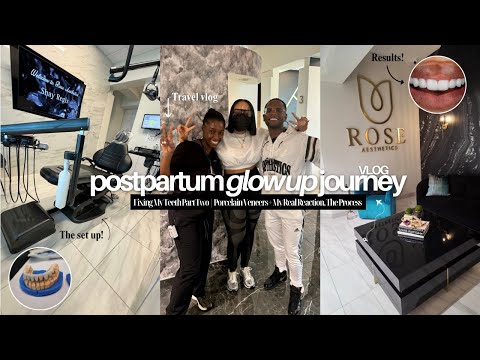 Glow Up Journey: Fixing My Teeth Pt.2 | Porcelain Veneers + My Real Reaction, The Process & More!