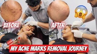 My Acne Marks/Scars Removal Treatment Journey | #SkinTalkWSar
