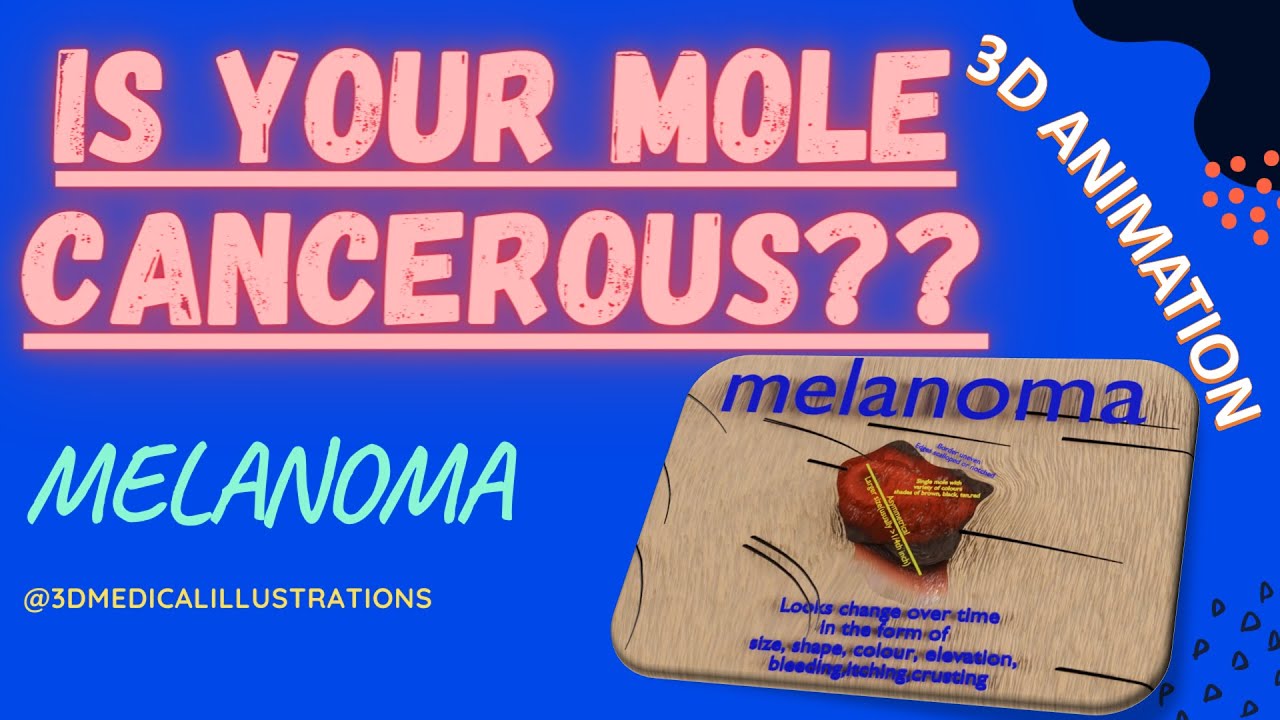 Mole nevus cancer Malignant melanoma differences 3D 3D Model