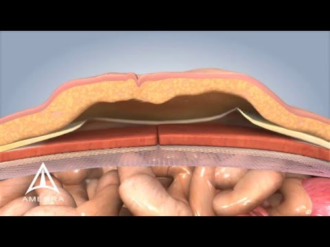 Ventral Hernia Repair - 3D Medical Animation