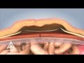 Ventral Hernia Repair - 3D Medical Animation