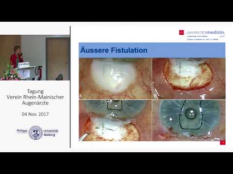 Prof. Esther M. Hoffmann: Minimal invasive Glaukomchirurgie ... 11-2017