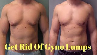 how to get rid of gynecomastia lumps | gynecomastia cure