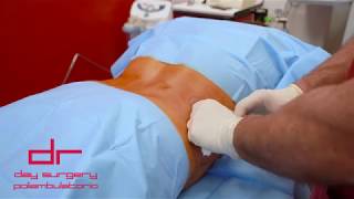 LIPOSUZIONE - Intervento di Chirurgia Estetica