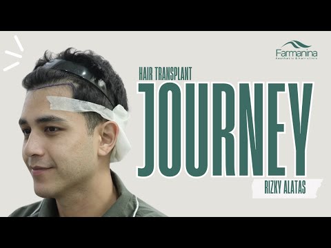 Rizky Alatas Hair Transplant Journey