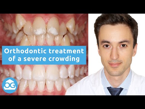 Orthodontic case report #1: Severe crowding. High angle.