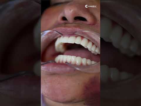 Fixed teeth in 2 days? Yes, it’s possible.