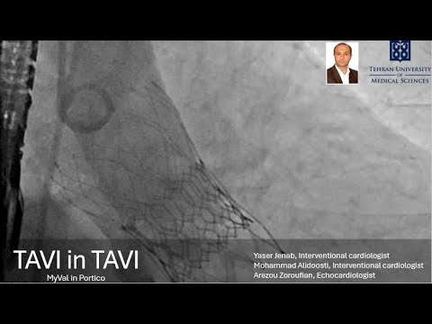 TAVI in TAVI (MyVal in Portico)