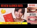 MY EXPERIENCE USING FLAT ALIGNERS 3 MONTHS OF MESSY TEETH BECOME STRAIGHT
