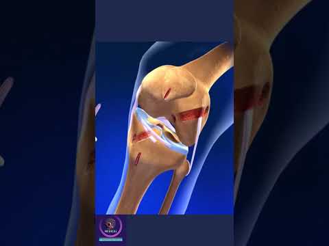 ACL Surgery, Knee Reconstruction #education #shorts