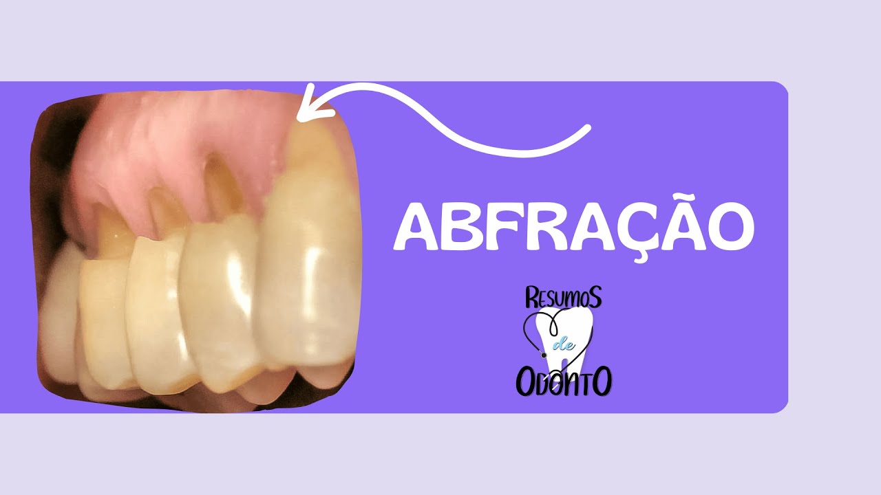 ABFRAÇÃO - Lesão Cervical Não Cariosa  (LCNC)  | Resumos de Odonto