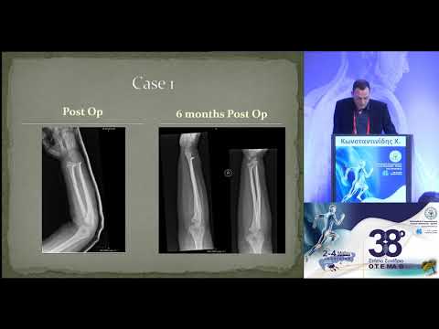 Κωνσταντινίδης Χ. - Treatment of forearm shaft fractures in children with titanium nails