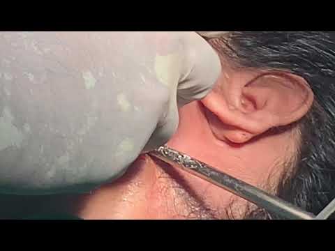 Lower Jaw Or Mandibular Distractor Being Placed To Get 30MM Of New Bone