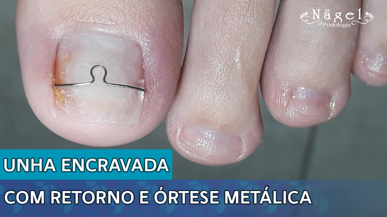 UNHA ENCRAVADA COM RETORNO E ÓRTESE METÁLICA