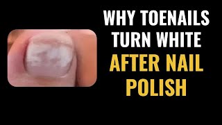 WHITE Toenails after Nail Polish - QUICK TREATMENT FROM PODIATRIST