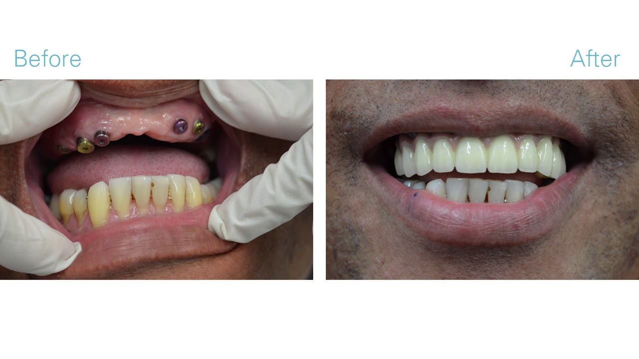 Full Mouth Reconstruction in NYC - Video