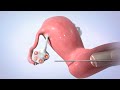 In Vitro Fertilization IVF