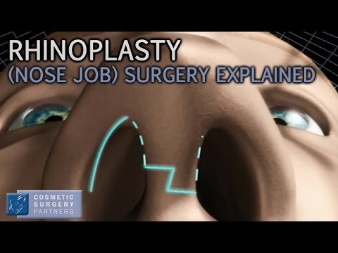 Rhinoplasty (Nose Job) explained - Cosmetic Surgery video animation