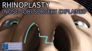 Rhinoplasty (Nose Job) explained - Cosmetic Surgery video animation