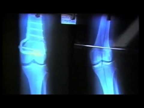 Dolore alla spalla braccio dellarticolazione intorpidimento Come trattare lernia intervertebrale