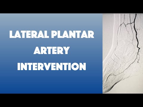 Lateral Plantar Artery CTO Recanalization (Trans-collateral Technique)