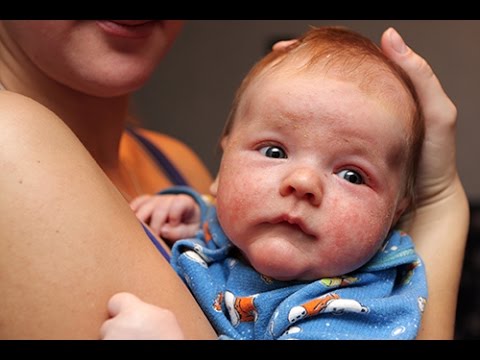 comment guerir eczema bebe