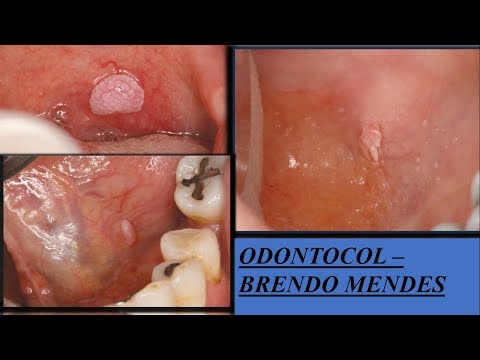 Orvos válaszol | HPVdoktor, Gyógyítja x papilloma vírust