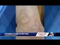 Skin rashes are possible rare symptom of