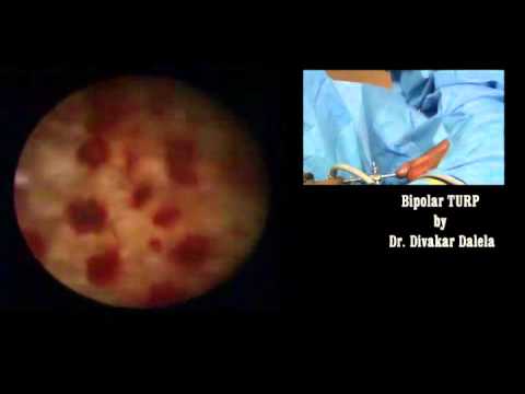 Bipolar TURP: cystoscopy