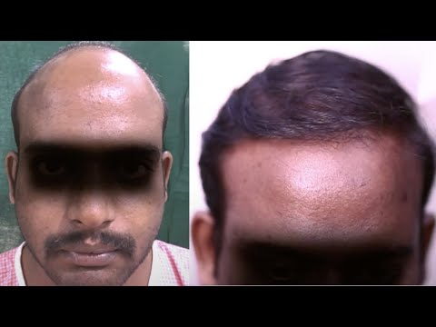 Hair Transplant Complete Procedure at Tamira Chennai