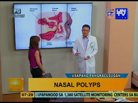 Folk remedyo para sa halamang-singaw sa ceiling Unguento ng halamang-singaw sa kuko ng paa