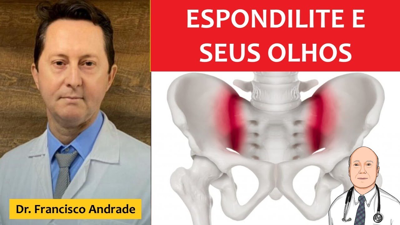 Os olhos na espondilite e espondiloartrites: uveites e outros problemas. Como tratar uveite?