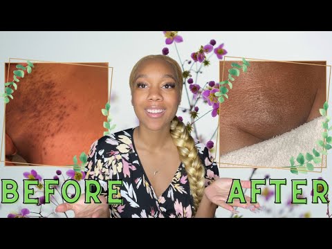 How to get rid of dark spots on bikini line from shaving Clearance