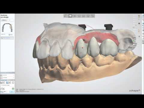 "Customized abutments and screw retained crowns"