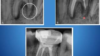 Overfilling in Endodontics Part I