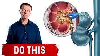 1st Sign of a Kidney Stone: Do This – Kidney Stone Remedies – Dr.Berg